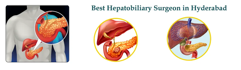 Best Hepatobiliary Surgeon in Hyderabad